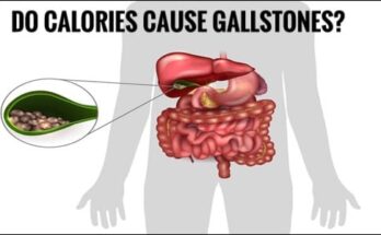 Do Calories Cause of Gallstones?